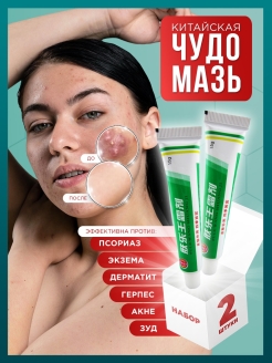 Отзыв на Китайская чудо мазь от псориаза, экземы, герпеса, лишае, акне, ожогов, ушибов, прыщей на лице 15гр